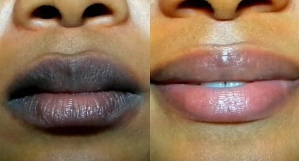 Lip Pigmentation