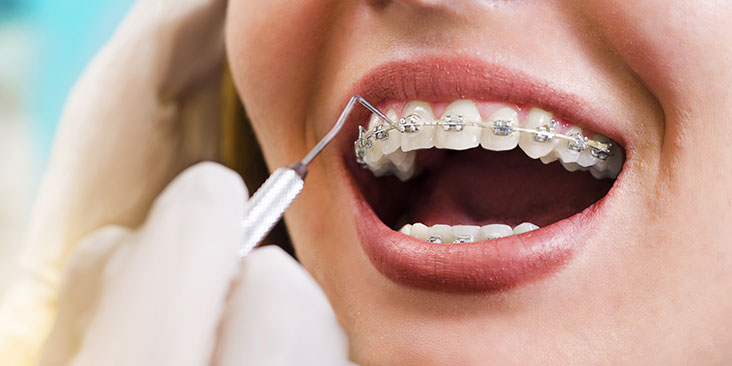 Orthodontic Treatment