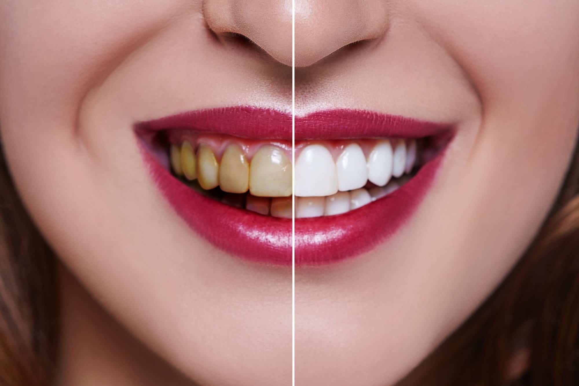 Tooth Whitening